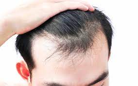 genetics hair loss 